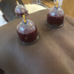 Hijama treatment session for pain relief and circulation improvement