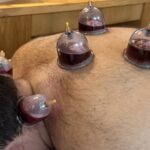 Cupping therapy setup with sterilised cups at Shiffa Healing Sanctuary