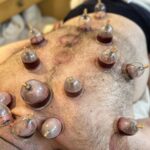 Wet cupping procedure as part of holistic health treatments